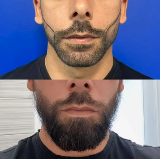 Avant / après d'une greffe de barbe : contour net et densité homogène