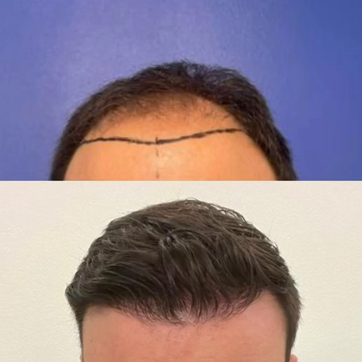 Avant / après greffe de cheveux : densification globale du crâne