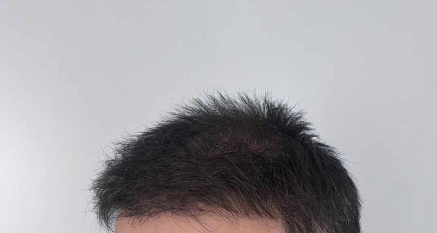 Après greffe de cheveux : densité restaurée