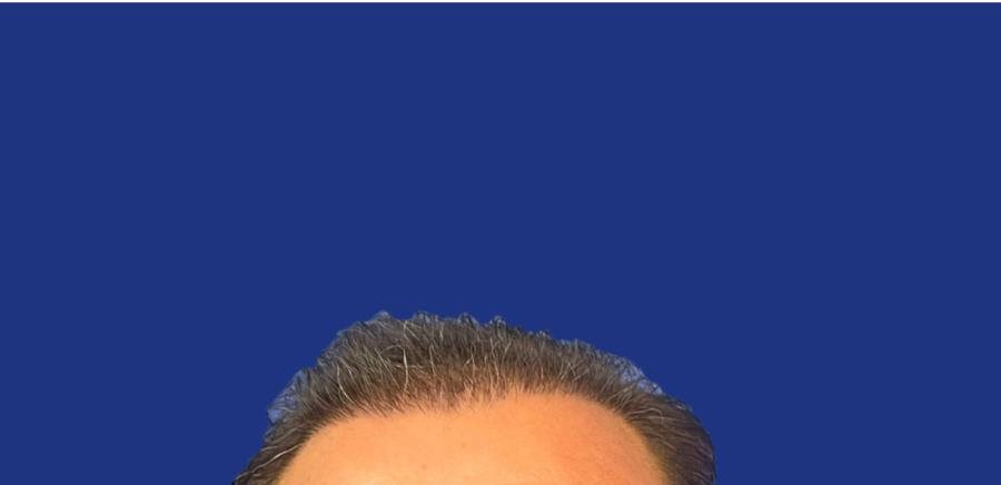 Golfes comblés après greffe de cheveux
