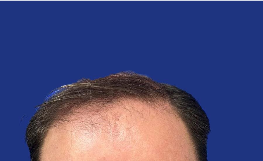 Golfes creusés avant greffe de cheveux