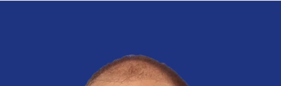 Cuir chevelu clairsemé avant greffe de cheveux