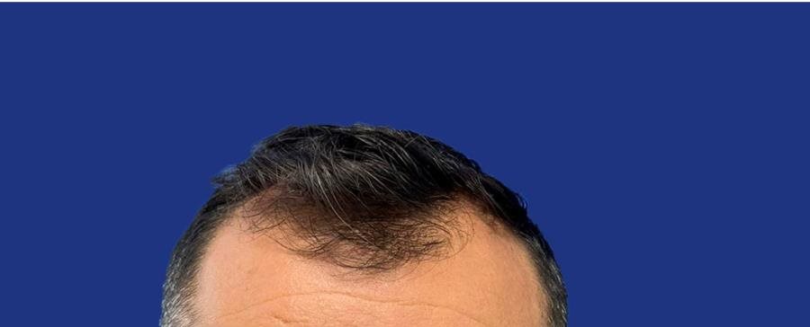 Recul de la ligne frontale avant greffe de cheveux