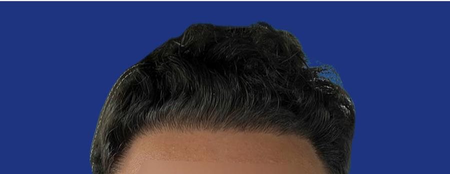 Ligne frontale dense après greffe de cheveux