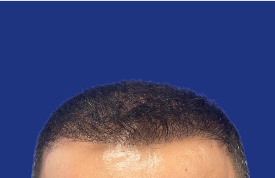 Couronne et vertex densifiés après greffe de cheveux