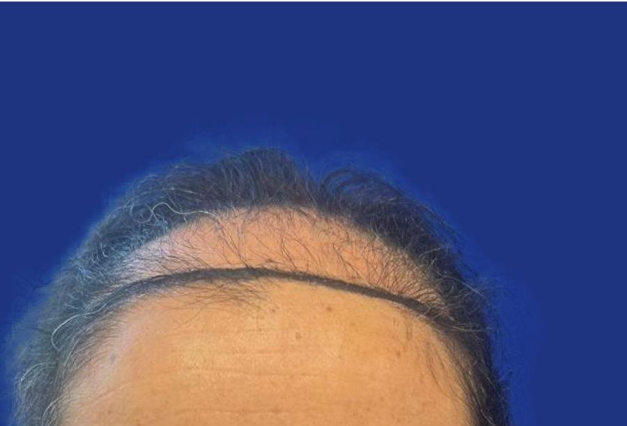 Ligne frontale clairsemée avant greffe de cheveux femme