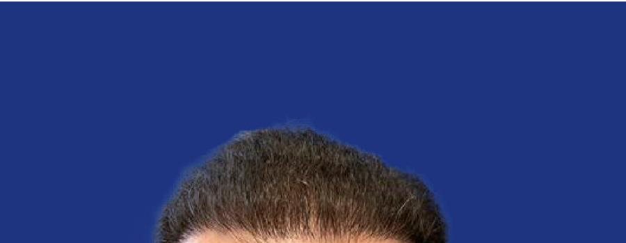 Golfes comblés après greffe de cheveux