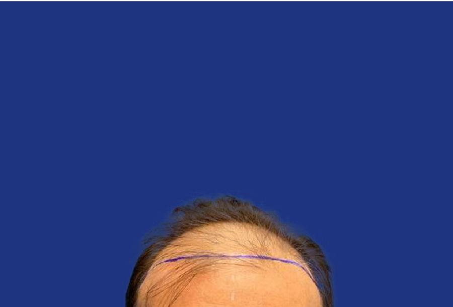 Golfes marqués avant greffe de cheveux